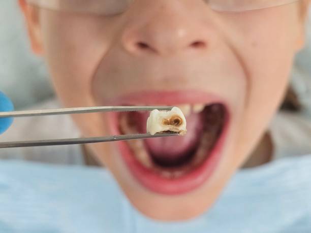 Urgent Tooth Repair in IN