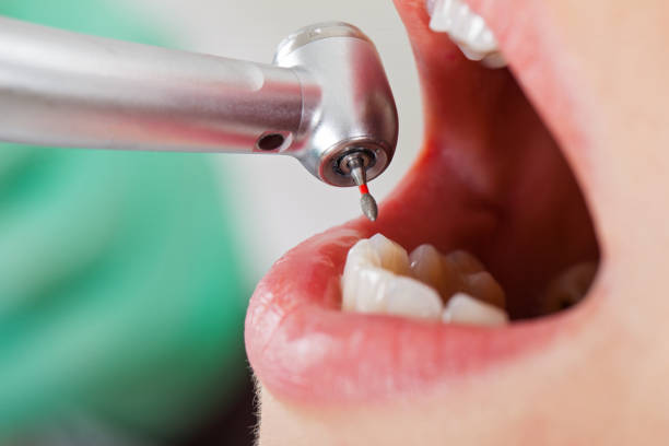 Emergency Dental Filling Replacement in IN